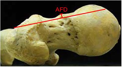 The Prevalence of Cam Morphology: A Cross-Sectional Evaluation of 3,558 Cadaveric Femora